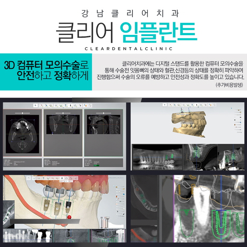 오스템임플란트 SOI임플란트 무엇이 다를까요? 관련 이미지 10