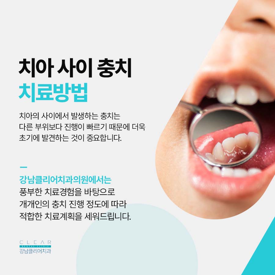 치아 사이 충치 조기에 발견해야 관련 이미지 3