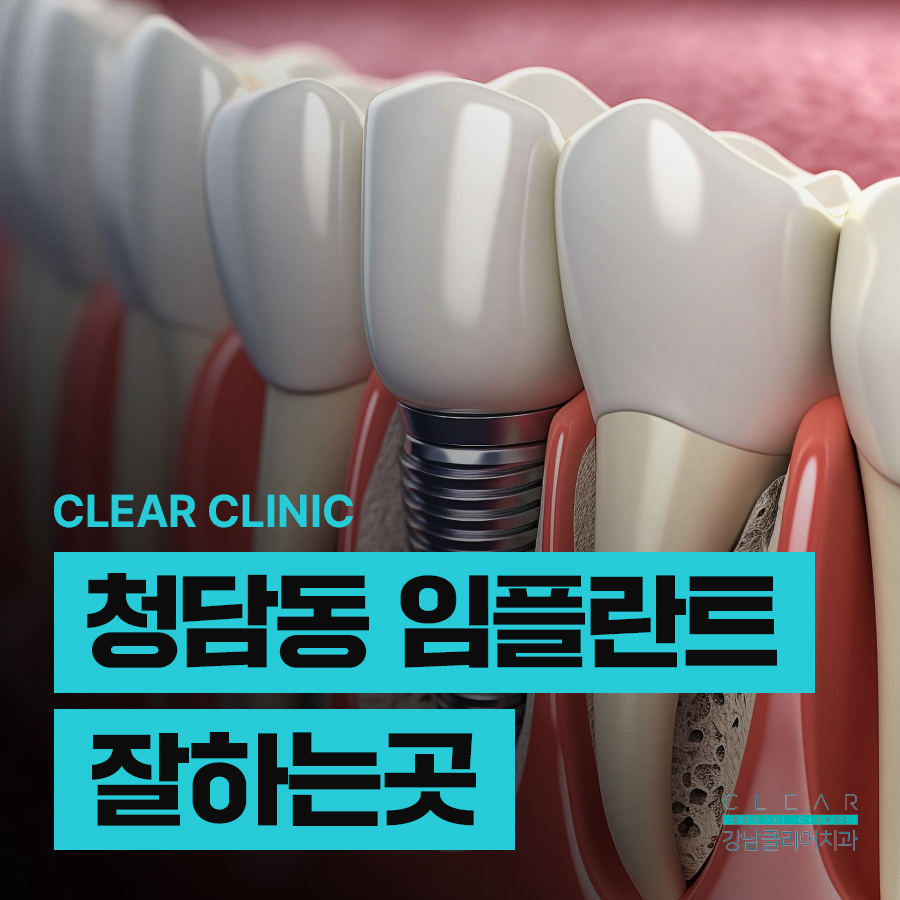 청담동 임플란트 잘하는곳 오래 사용하고 싶다면 관련 이미지 1