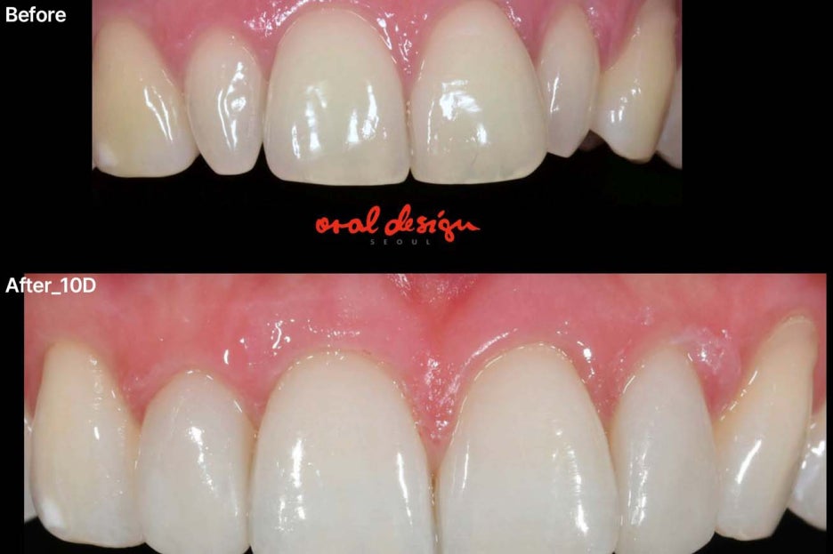 강남클리어치과 라미네이트 적절한 치아삭제가 관건 관련 이미지 7