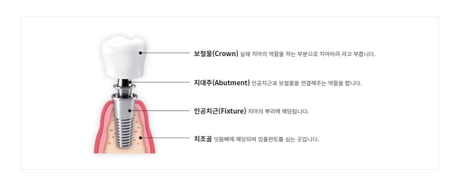 임플란트 실비 가능한지 찾는다면? 관련 이미지 6