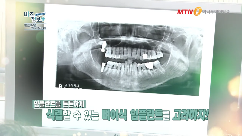 강남역임플란트치과 뼈이식 방법으로 보다 탄탄하게 관련 이미지 9