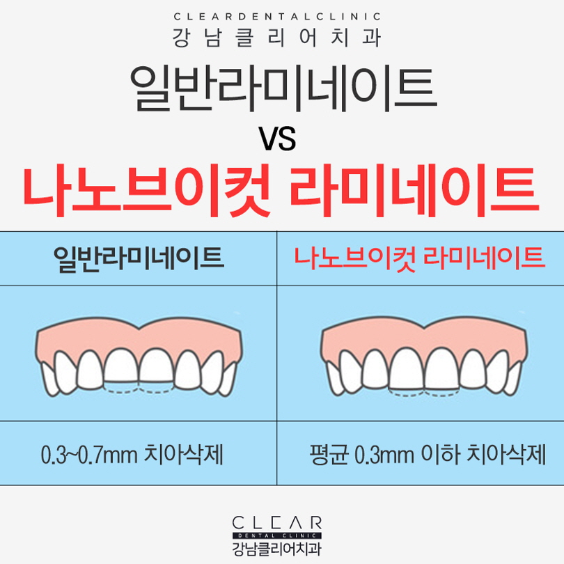 바르고 고른 치아 라미네이트로 만들기 관련 이미지 5