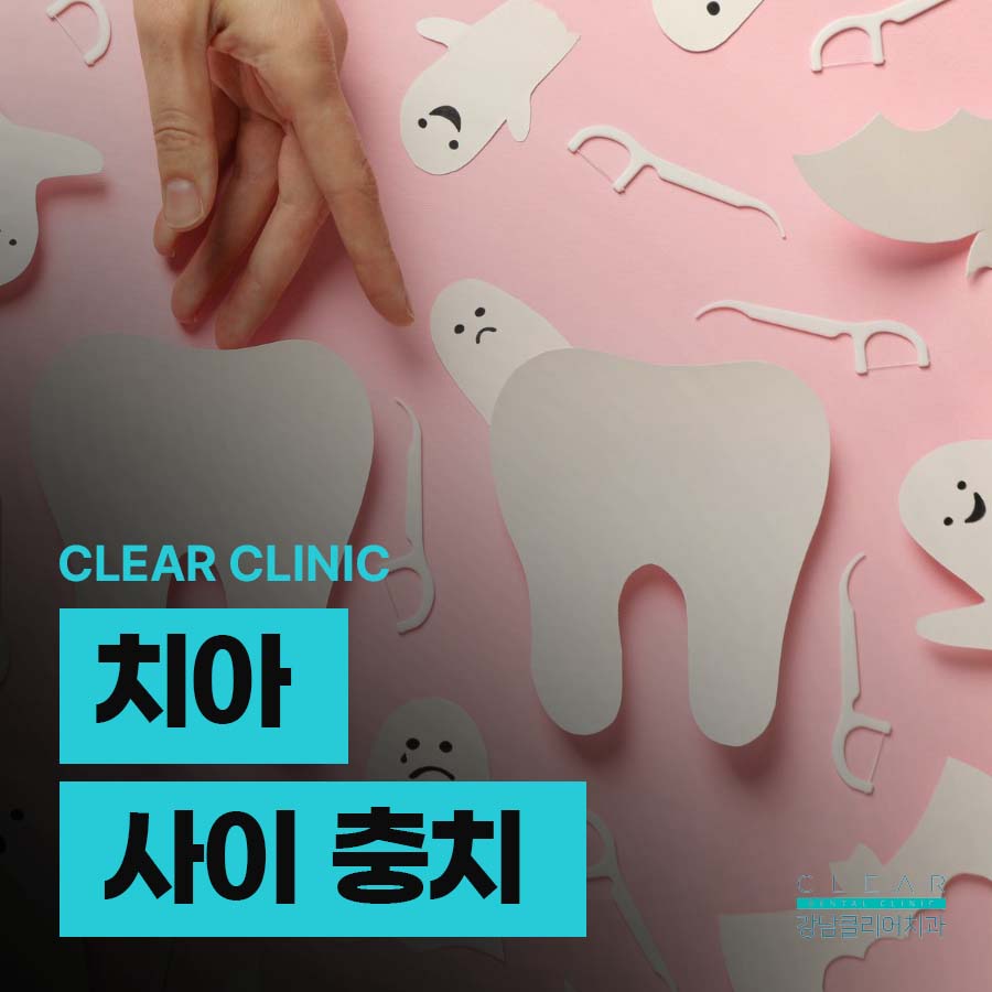 치아 사이 충치 보이지 않으니까 더 주의해야 관련 이미지 1
