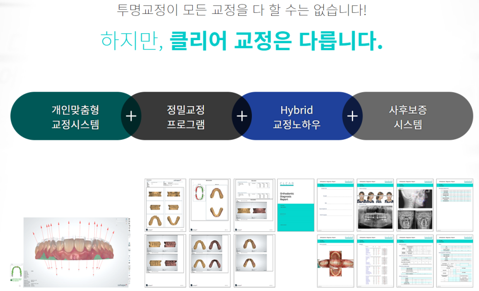 서울교정치과 심미성 좋은 클리피씨 방법으로 관련 이미지 3