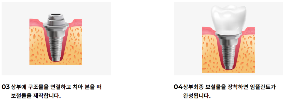 서울임플란트잘하는치과 개인에 따라 맞춤 식립으로 관련 이미지 7