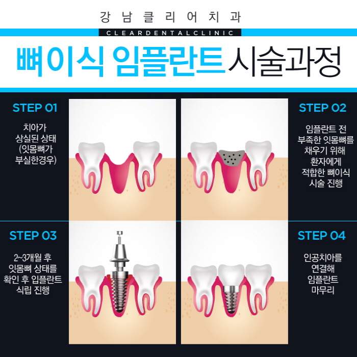 뼈이식임플란트 무엇이며 뼈이식은 왜 중요할까? 관련 이미지 6