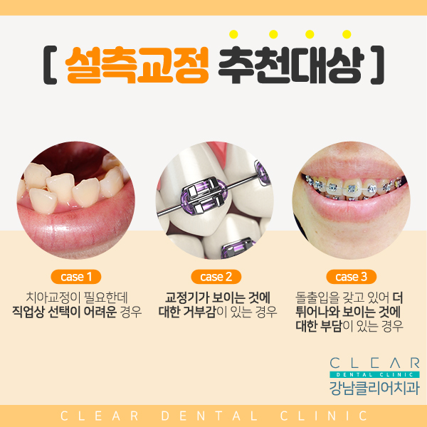 강남역 안보이는 시크릿교정 설측교정! 관련 이미지 3