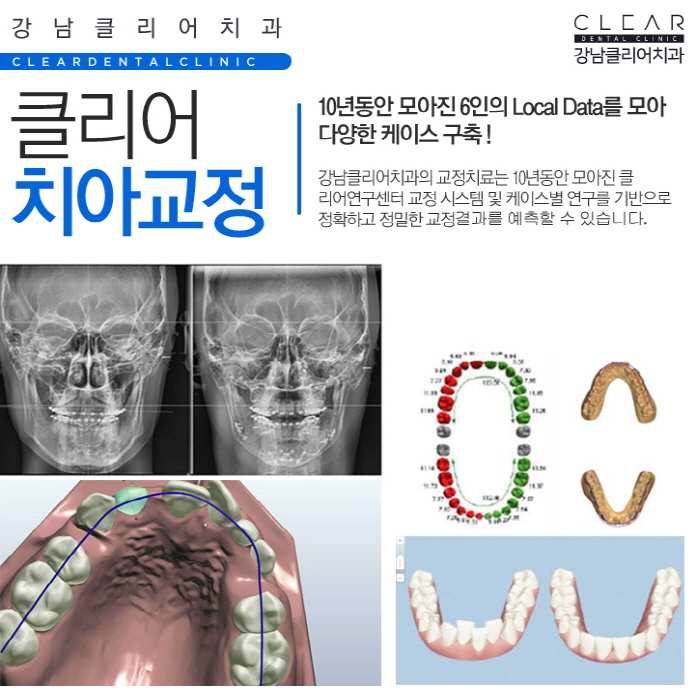 치아부분교정 앞니부분교정 정확한 진단이 중요 관련 이미지 8
