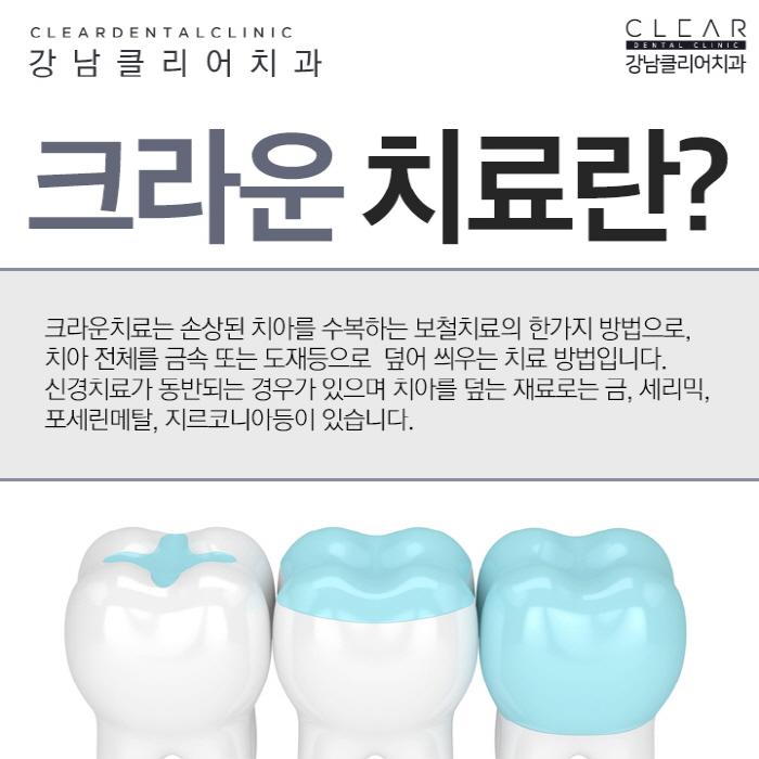 치아 크라운 치료 어떤 종류가 있고 언제 필요한가? 관련 이미지 2