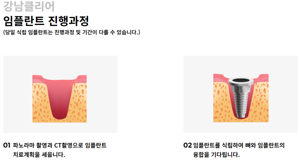 서울임플란트잘하는치과 개인에 따라 맞춤 식립으로 관련 이미지 6