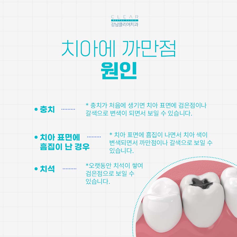 클리어치과 치아 까만점 원인 치료방법은? 관련 이미지 2