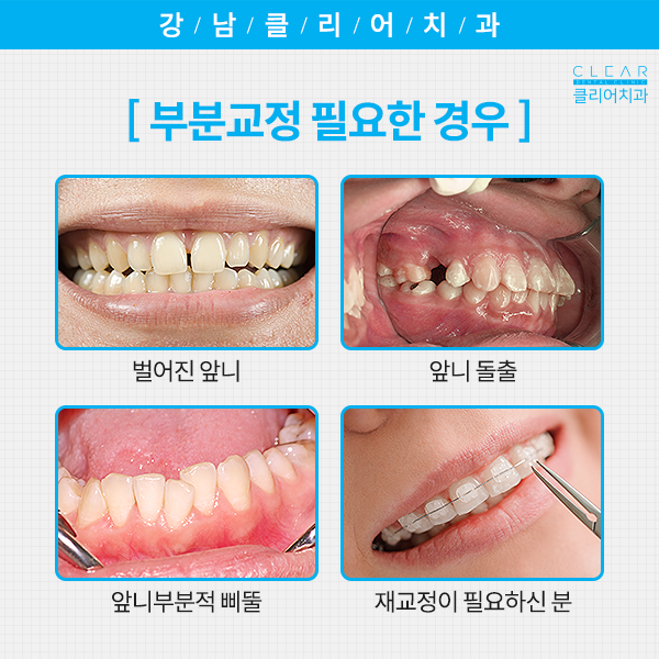 전체교정말고 부분적으로 할 수는 없을까요? 관련 이미지 3