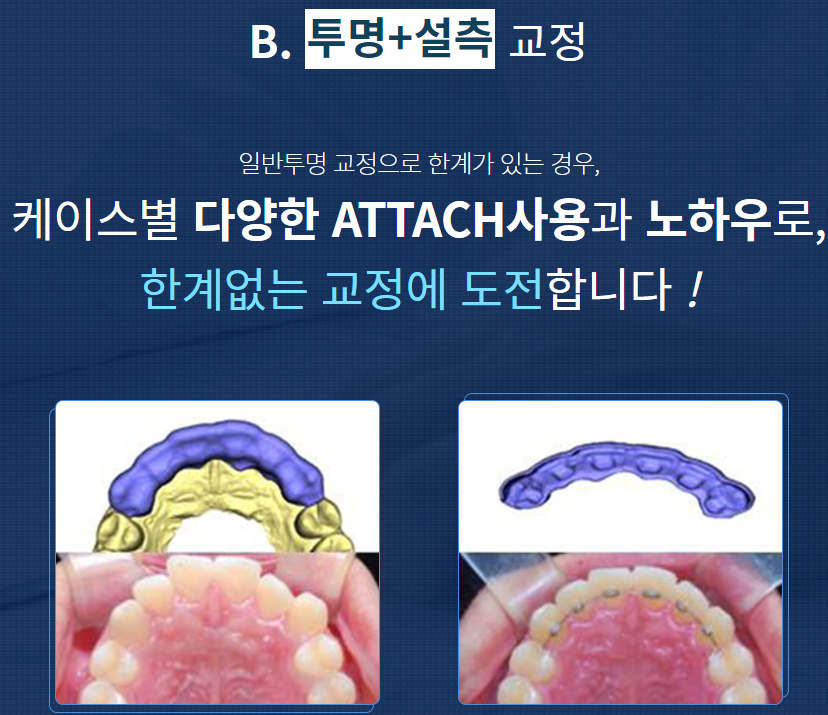 강남치아교정 기간 단축으로 불편함 적게 관련 이미지 7