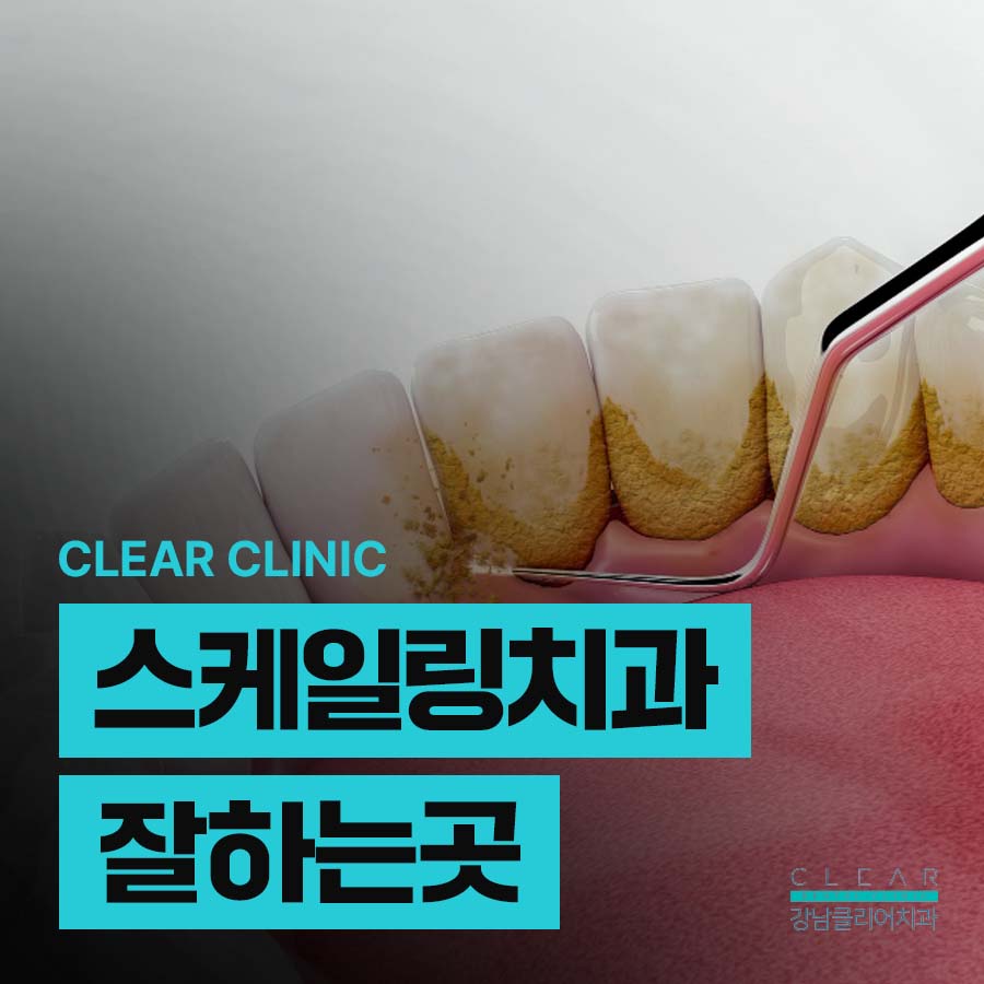 스케일링치과잘하는곳 건강한 잇몸 치아를 생각하면 관련 이미지 1