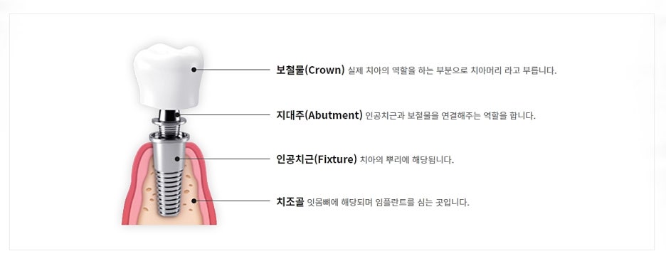 임플란트 강남역치과 준비된 곳을 가야지 관련 이미지 5
