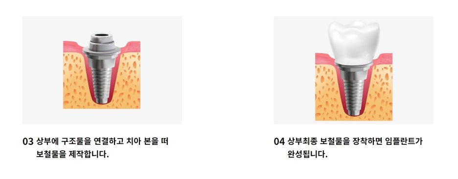 강남역 임플란트 잘하는곳 판단하고 결정해야 관련 이미지 6
