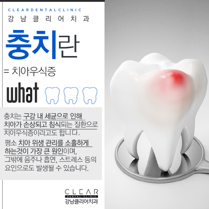 강남역충치 치료 개인별 맞춤형 최적의 솔루션 치료 관련 이미지 2