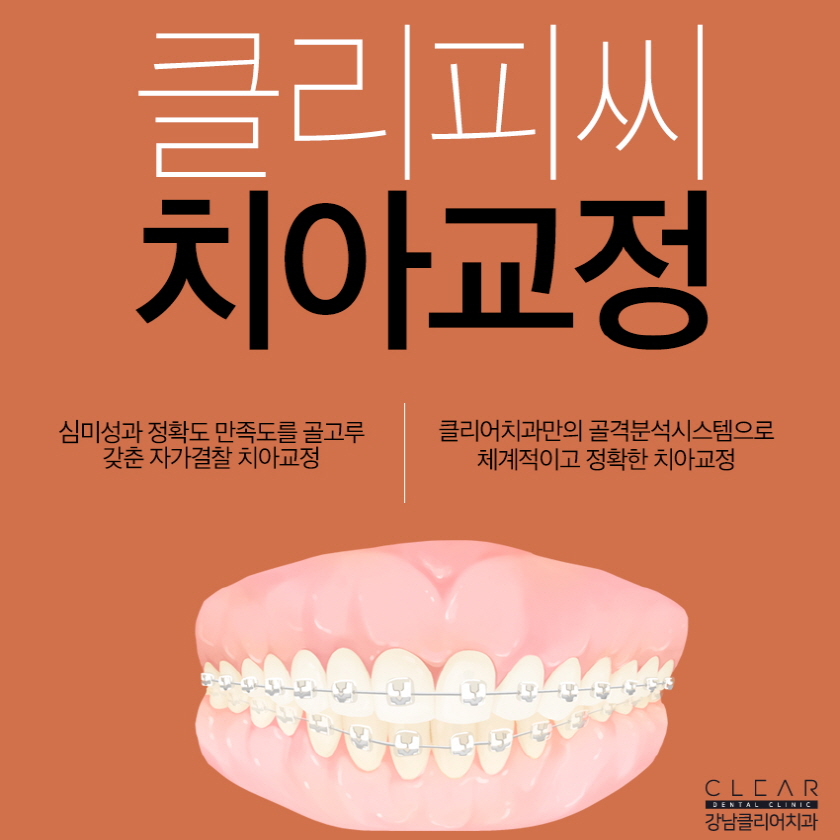강남클리피씨교정 고르게 하지만 티는 덜나는 관련 이미지 1