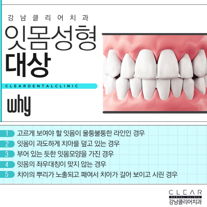연예인잇몸성형, 잇몸성형 자신감 있는 미소 되찾기 관련 이미지 4