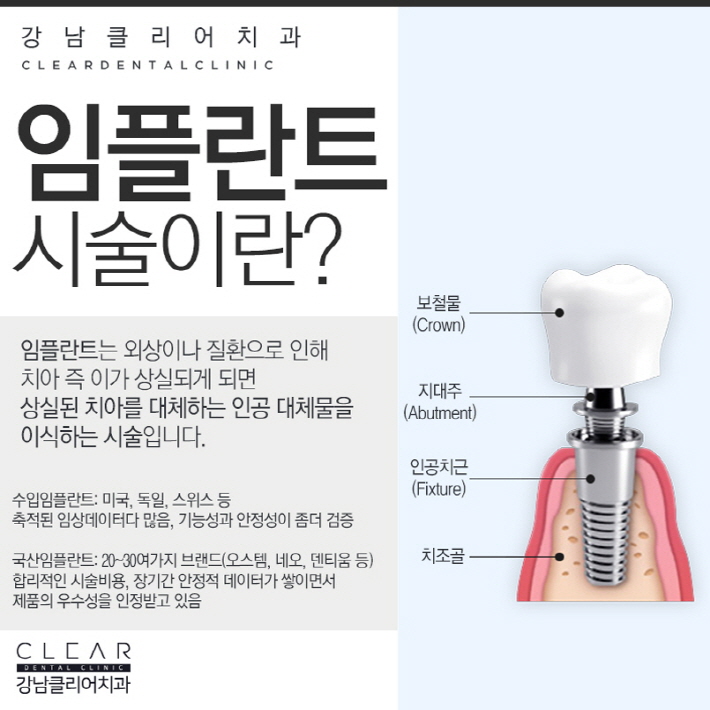 국산임플란트 가격 안정성 모두 경쟁력있어 관련 이미지 2