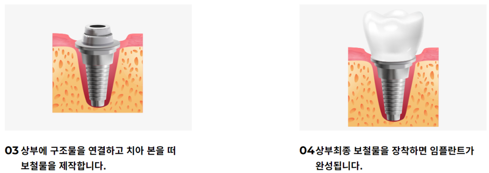 서초동임플란트치과 측방력까지 고려한 치료 관련 이미지 5