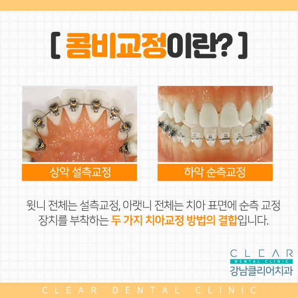강남역 안보이는 시크릿교정 설측교정! 관련 이미지 4