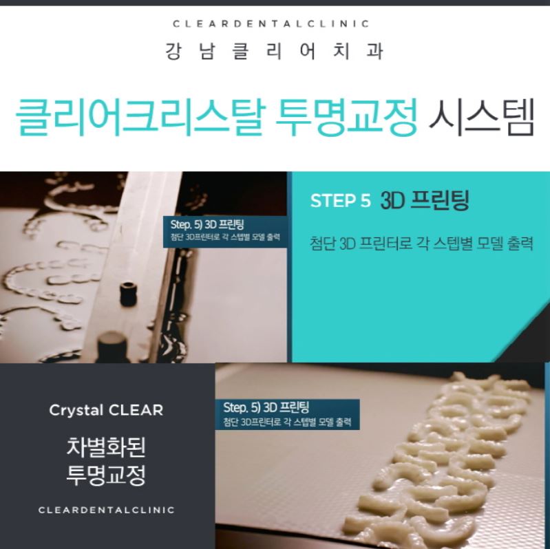 강남역투명교정 자연스러운미소를 가져보세요! 관련 이미지 9