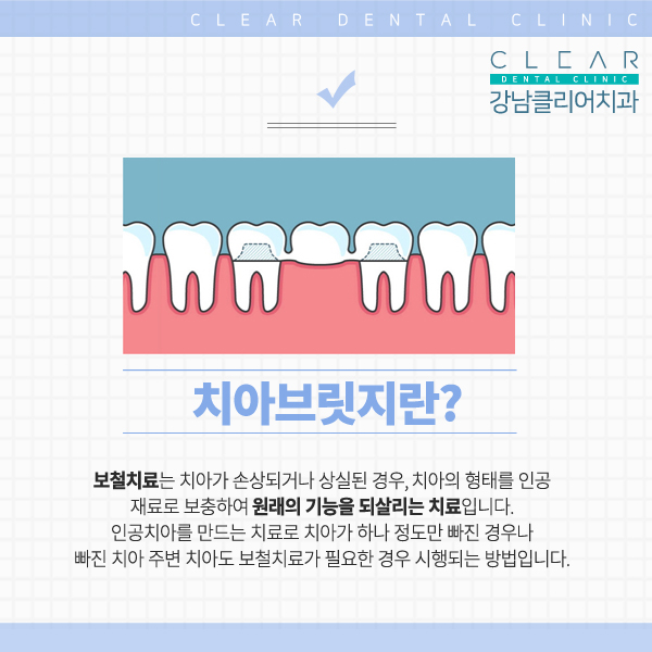 강남역치과 추천 치아 보철치료 관련 이미지 7