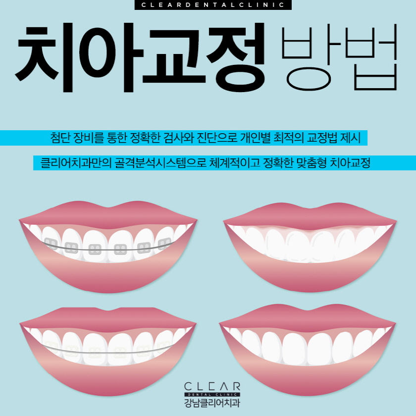 강남역치아교정치과 가지런한 치아 만드는 교정방법들 관련 이미지 1