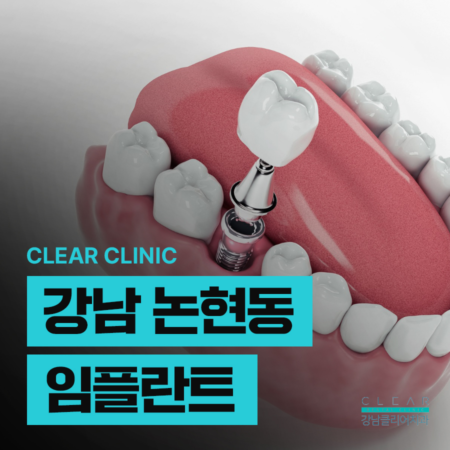 강남 논현동 임플란트 맞춤형으로 나한테 꼭 맞게 관련 이미지 1