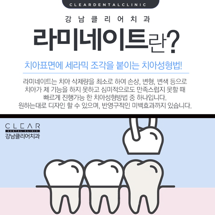 치아라미네이트 나노V컷으로 해야하는 이유! 관련 이미지 2