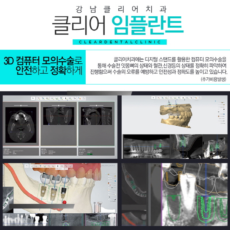 강남역임플란트 가격 무엇때문에 달라지게 될까? 관련 이미지 4