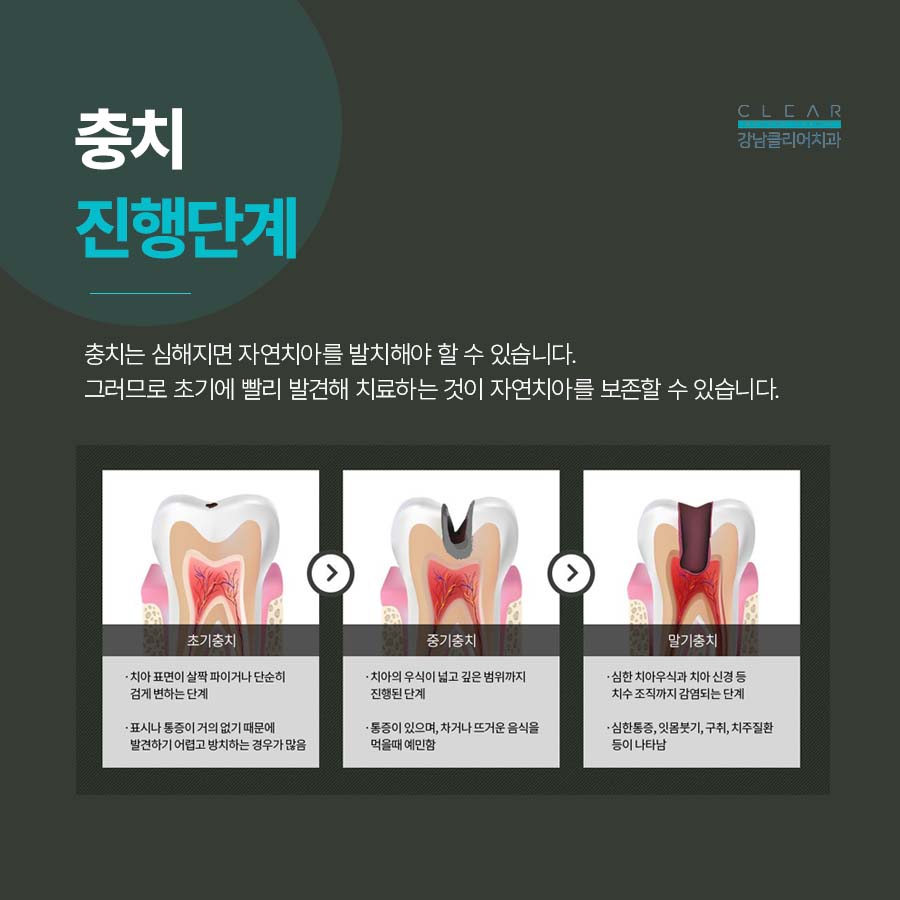 강남클리어치과 충치치료 후 통증 이유 정리 관련 이미지 4