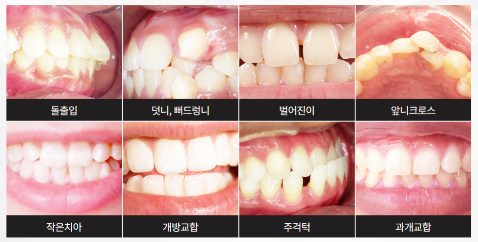 강남클리피씨교정 단 기간에 티나지 않게 관련 이미지 2