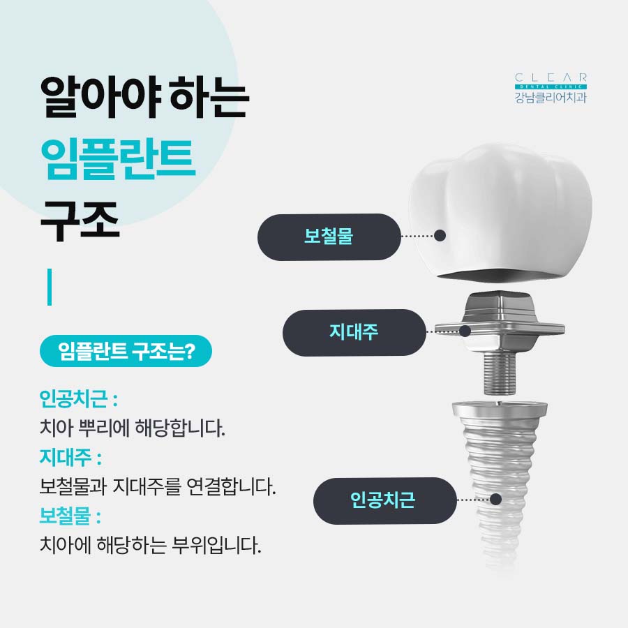 임플란트 빠졌을때 빠지는 이유 대처법 알려드려요 관련 이미지 2