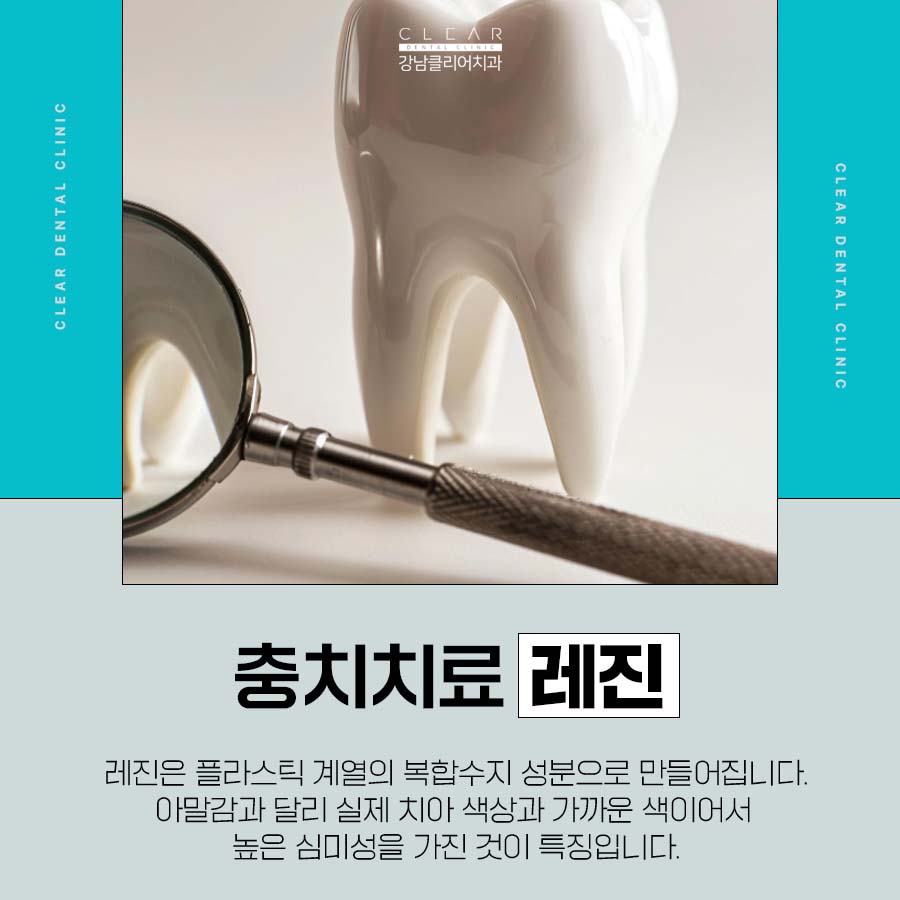 충치치료 레진 아말감 차이 비교점 관련 이미지 3