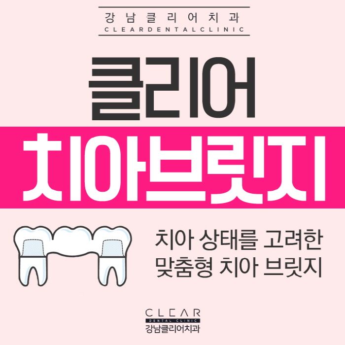 치아브릿지 강남치아브릿지도 이제 맞춤형으로 관련 이미지 1