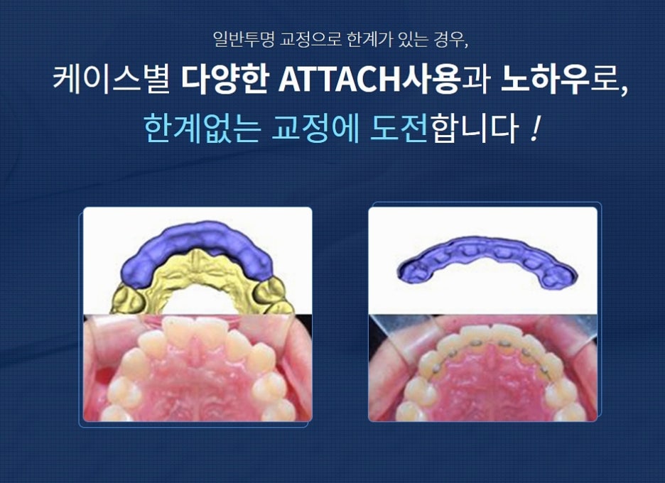 클리어치과 교정 아무데서나 말고 신중하게 관련 이미지 4