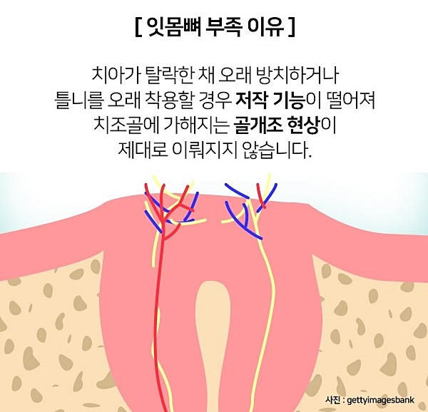 잇몸뼈가 부족해 임플란트 수술 어렵다면? 관련 이미지 4