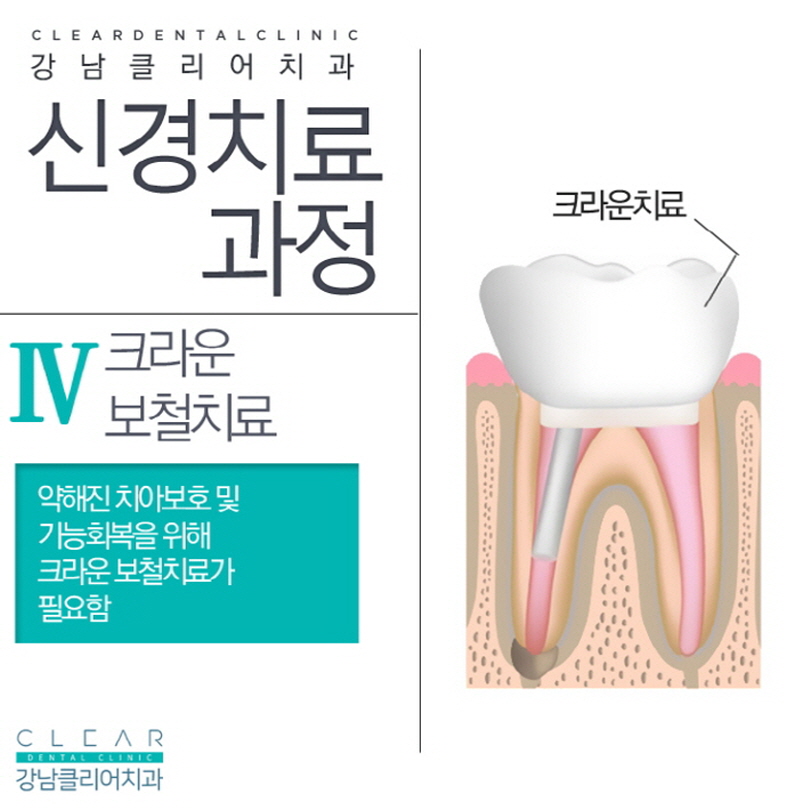 강남역치아신경치료 간단한 치료가 아니다 관련 이미지 6