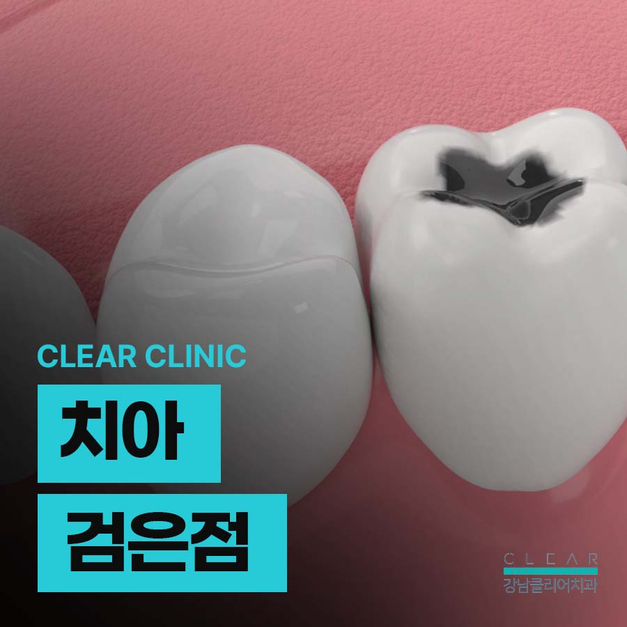 치아 검은점 원인 치료방법 정리 관련 이미지 1