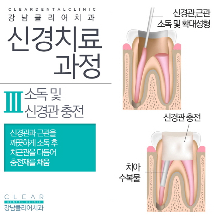 치아 신경치료 가볍고 쉽게 생각해선 안된다 관련 이미지 6