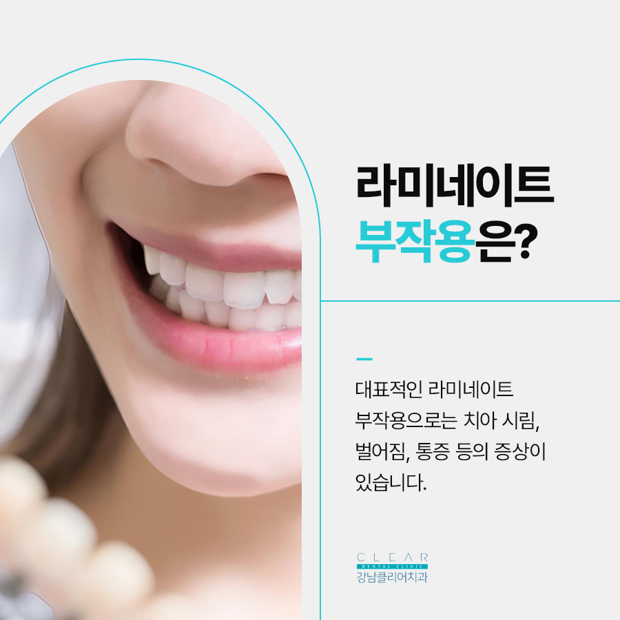 라미네이트 연예인 부작용 주의사항 관련 이미지 2