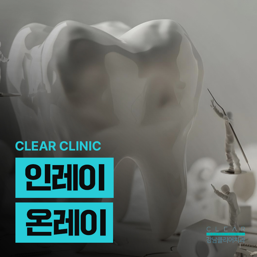 인레이 온레이 치료 다른점은 무엇일까 관련 이미지 1
