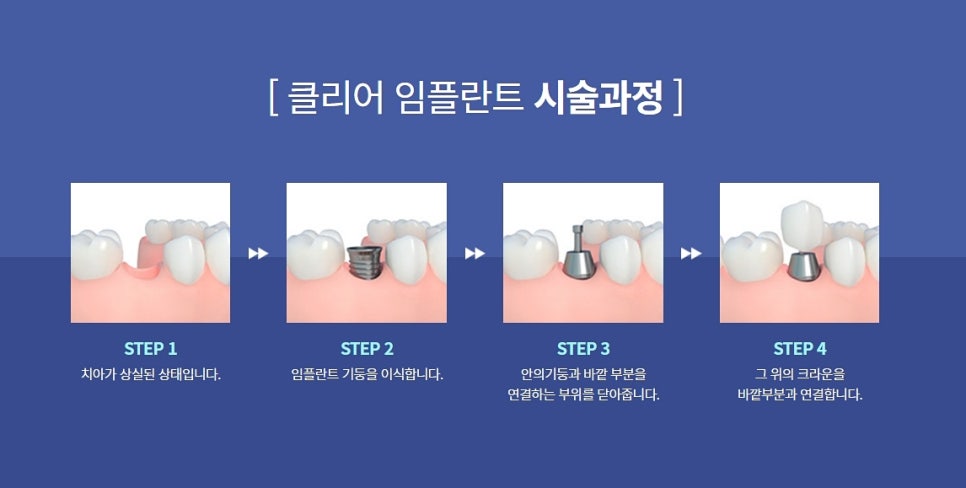 강남임플란트 찾아보고 결정하자 관련 이미지 7