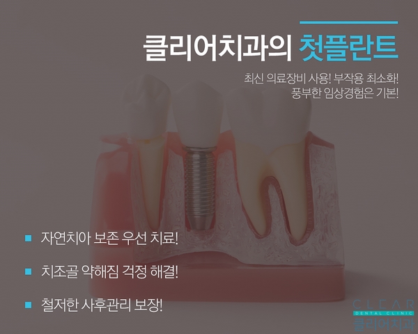 내 생에 첫 임플란트 관련 이미지 2