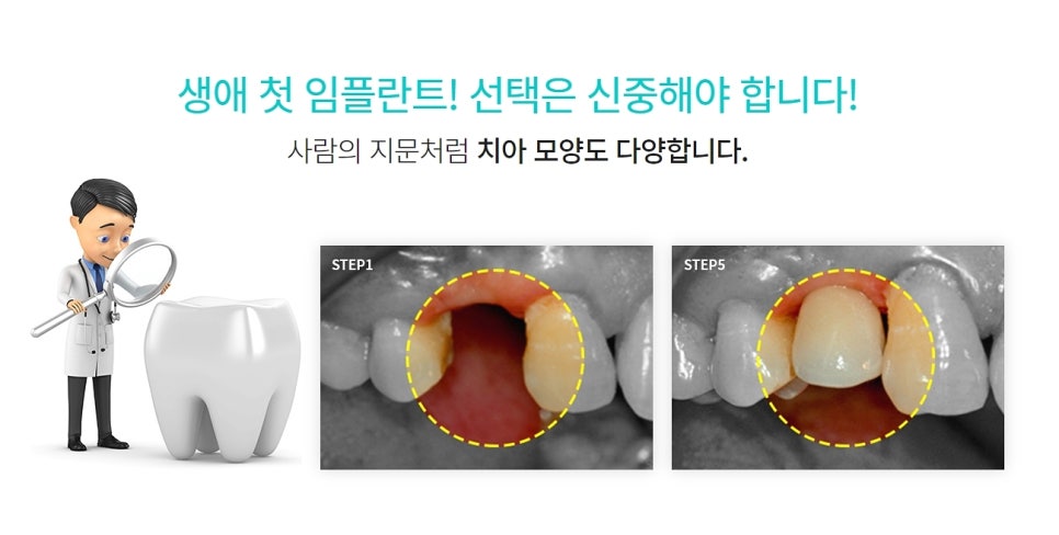 클리어치과 임플란트 비용 후기 찾는다면 관련 이미지 4