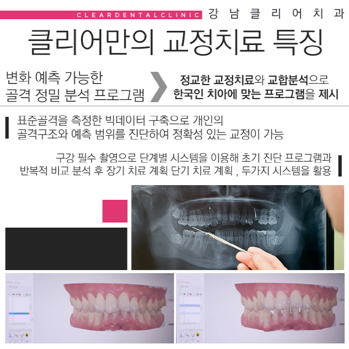 강남역 클리피씨교정 심미성과 기능성 1석2조 효과 관련 이미지 5