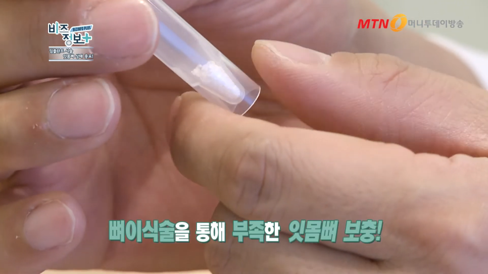 임플란트 주의사항 잇몸뼈의 상태도 봐야 관련 이미지 6